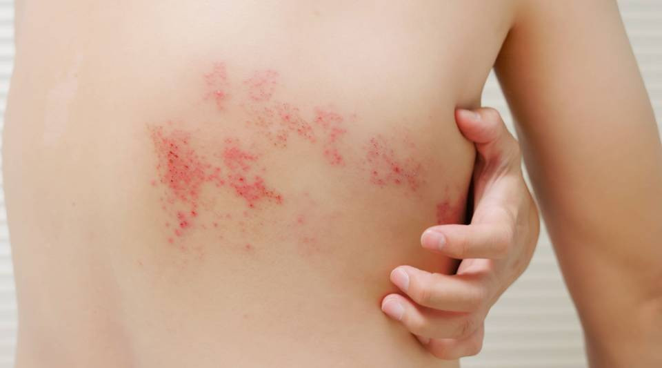 Alego aprova projeto que garante a vacinação contra o herpes-zóster na rede estadual